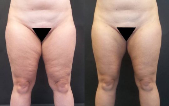 31 yo F 3 months post lipo with BT to medial thighsknees