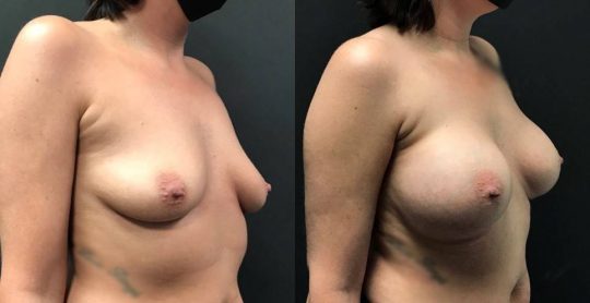 3 months post breast augmentation with Sientra silicone implants_ L 505HP R 565HP (submuscular)
