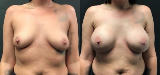 front view of a female patient before and 3 months after breast augmentation