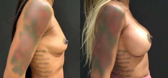 side view of a female patient before and 6 months after breast augmentation