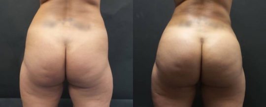female patient before and 1 month after BBL Brazilian Butt Lift