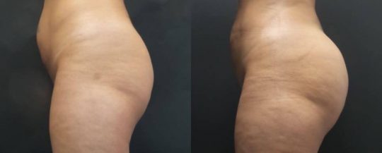 side view of a female patient before and 1 month after BBL Brazilian Butt Lift