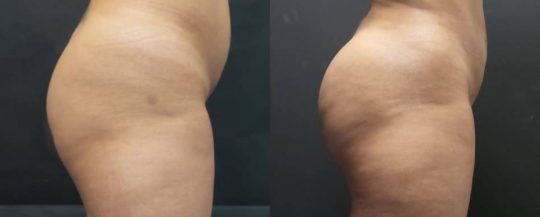 side view of a female patient before and 1 month after BBL Brazilian Butt Lift