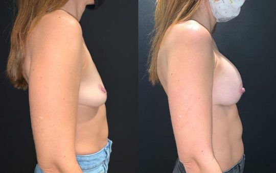 side view of a female patient before and 1 month after breast augmentation