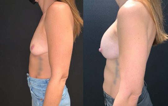 side view of a female patient before and 1 month after breast augmentation