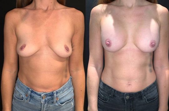 front view of a female patient before and 1 month after breast augmentation