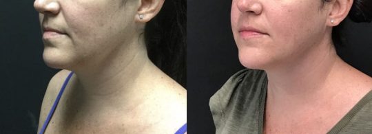 side view of a female patient's lower face before and 1 month after submental lipo with with accutite and morpheus