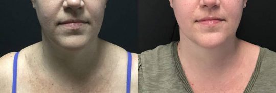front view of a female patient's lower face before and 1 month after submental lipo with accutite and morpheus