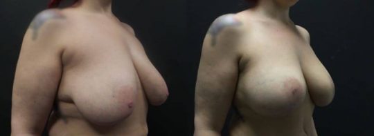 42 yo F 5 months post breast lift with aug sientra 385 MP submuscular42 yo F 5 months post breast lift with aug sientra 385 MP submuscular