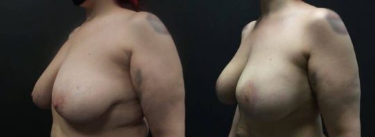 42 yo F 5 months post breast lift with aug sientra 385 MP submuscular