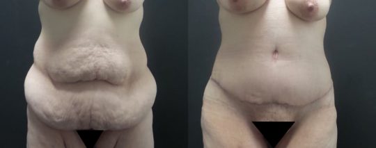 43 yo F 1 month post abdominoplasty