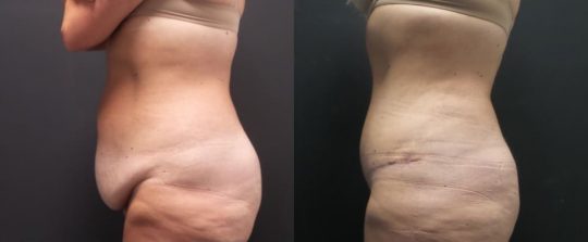 48 yo F 3 months post abdominoplasty