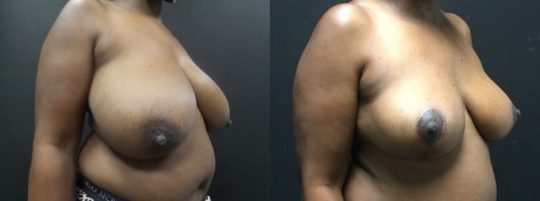 side view of a female patient before and 3 months post breast reduction