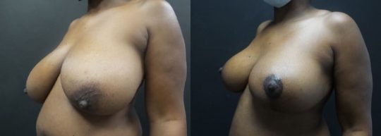 48 yo F 3 months post breast reduction
