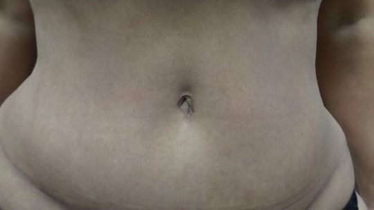 51 yo F 6 months post abdominoplasty (bellybutton)