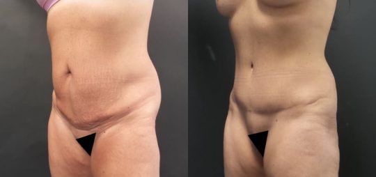 51 yo F 9 months post abdominoplasty