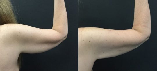54 yo F 1 month post lipo to arms with bodytite and morpheus