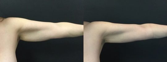 54 yo F 1 month post lipo to arms with bodytite and morpheus