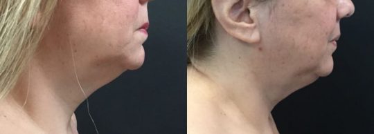 side view of a female patient's lower face before and 1 month after submental lipo with facetite and morpheus