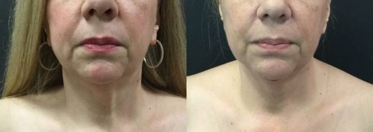 54 yo F 1 month post submental lipo with facetite and morpheus