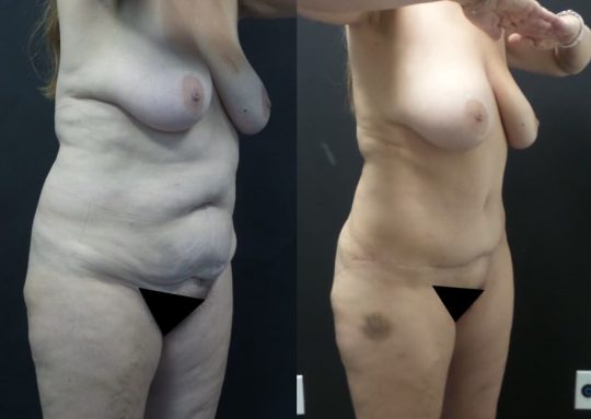 54 yo F 6 months post abdominoplasty