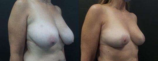 55 yo F 6 months post breast reduction