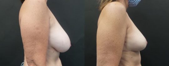 side view of female patient before and 6 months after breast reduction