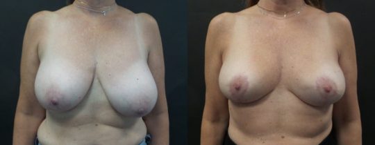 front view of female patient before and 6 months after breast reduction