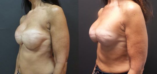 side view of female patient before and 9 months after breast reconstruction
