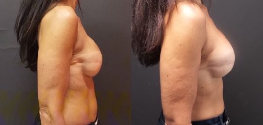 side view of female patient before and 9 months after breast reconstruction