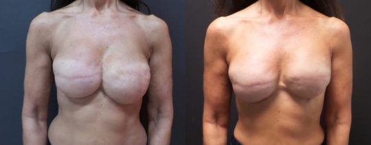 front view of female patient before and 9 months after breast reconstruction