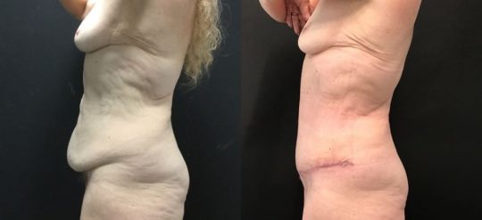 58 yo F 1 month post abdominoplasty