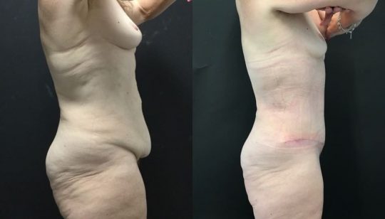 58 yo F 1 month post abdominoplasty