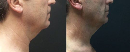 59 yo M 3 months post submental lipo with facetite and morpheus