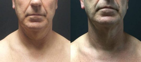 59 yo M 3 months post submental lipo with facetite and morpheus