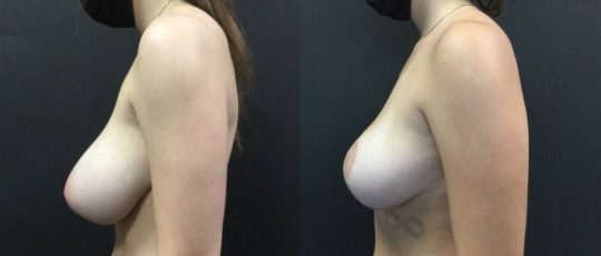 side view of a female patient before and after Breast Reduction