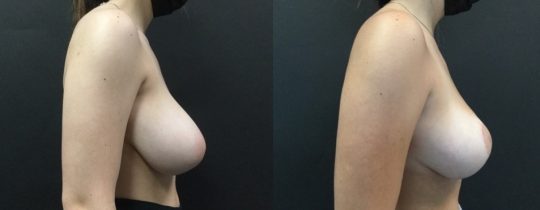 Case #165 Breast Reduction