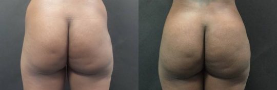 female patient before and after BBL Brazilian Butt Lift