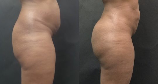 side view of a female patient before and after BBL Brazilian butt Lift