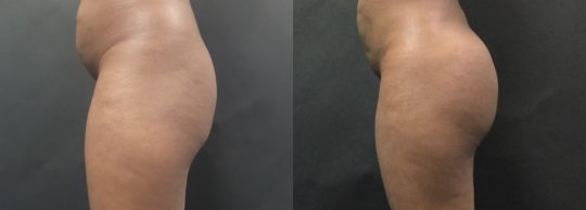 side view of a female patient before and after BBL Brazilian Butt Lift