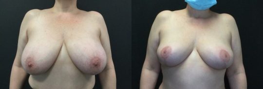 front view of a female patient before and after Breast Reduction