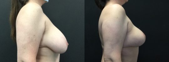 Case #166 Breast Reduction