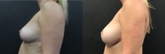 Case #29 Breast Augmentation