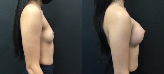 Case #32 Breast Augmentation