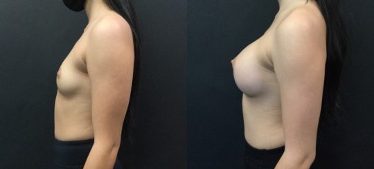 side view of a female patient before and after Breast Augmentation