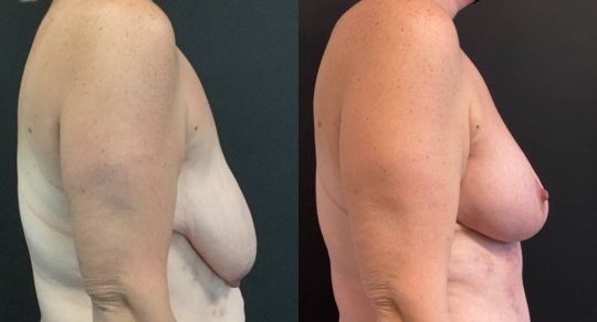 side view of a female patient before and after Breast Lift with Augmentation