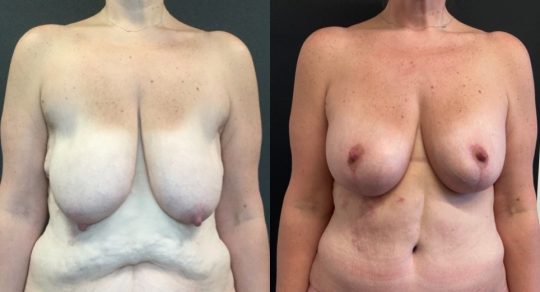 Case #22 Breast Lift with Augmentation