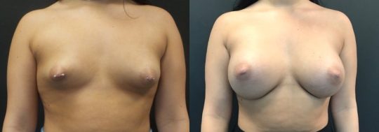 Case #33 Breast Augmentation