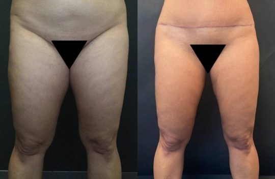 Case #111 3 months post Liposuction to thighs and knees with morpheus8
