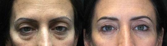 front view of a female patient's eyes before and after Blepharoplasty